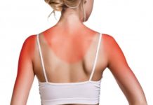 Güneş Yanığı İçin Bakımlar