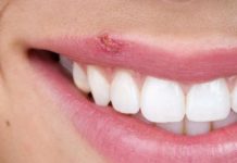 Uçuklar İçin Tedavi Yöntemleri