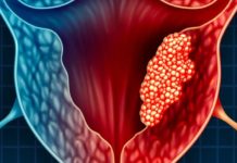 Menopoz Sonrası Yaşanan Kanamalar