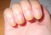 Tırnak Sararmasının Nedenleri