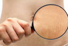 Doğum Çatlaklarına Doğal Yöntemler