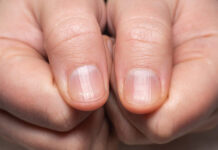 Tırnak Lekesinin Nedenleri